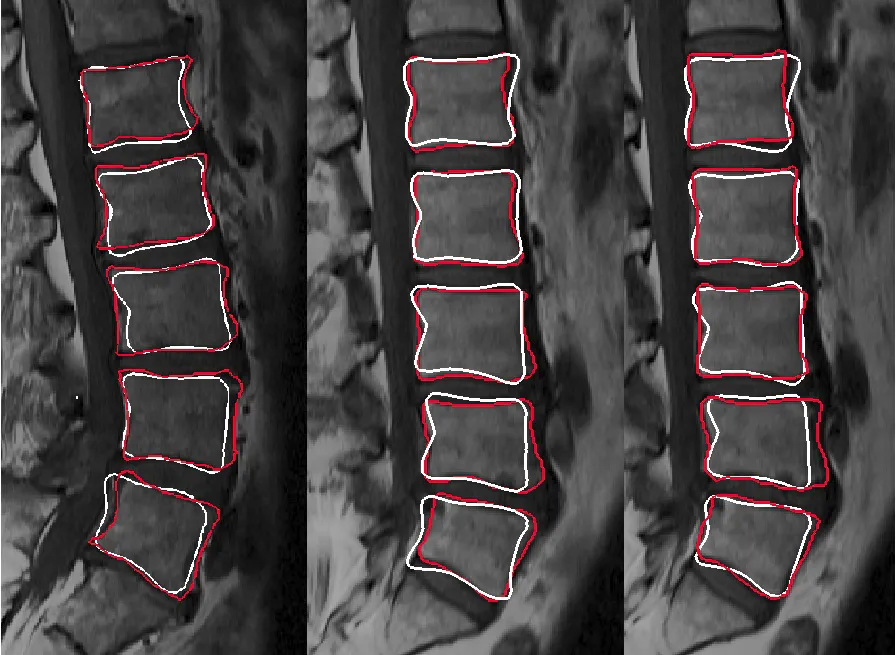 CT segmentation of vertebral anatomy for PEKK implant design